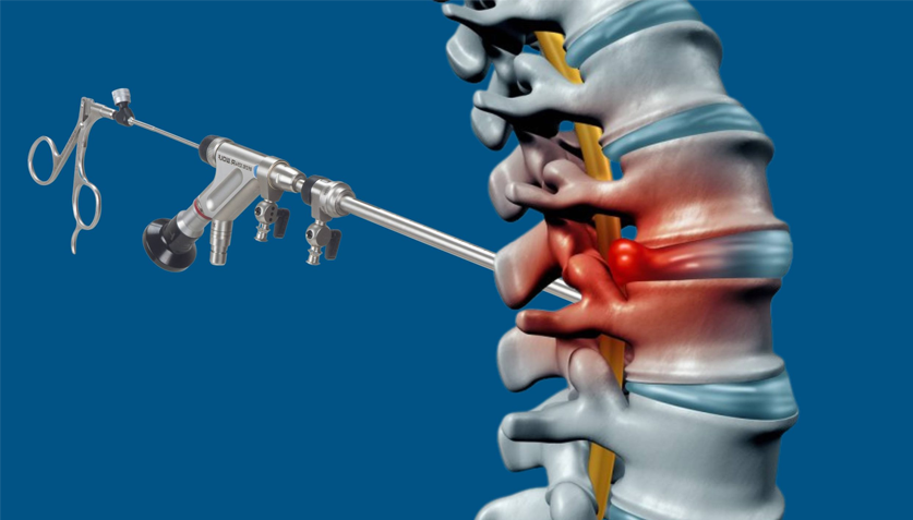 Endoscopic Spine Surgery in Chennai