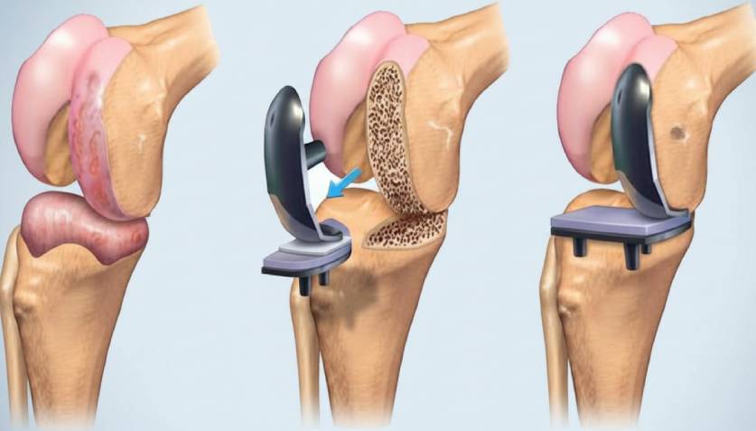 Joint Replacement Surgery in Anna Nagar