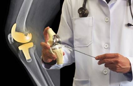 Joint Replacement Surgery in Chennai