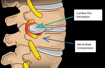 Micro Tubular discectomy in Anna Nagar