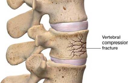 Osteoporotic Spine Fractures Treatment Chennai